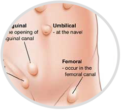 Hernias